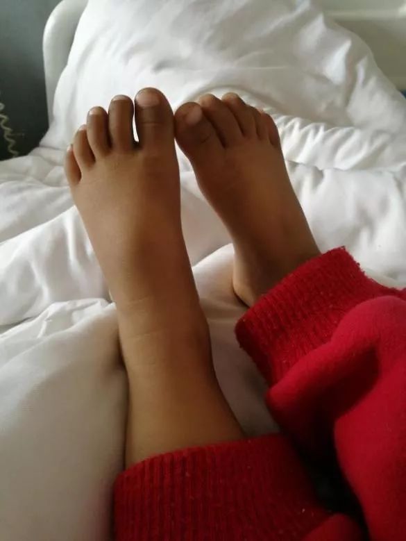 四期转移、半年复发、耐药、转院,患生殖细胞瘤的丫丫终踏上幼儿园之路