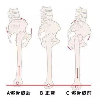 三招矫正长短腿,长短腿懒人矫正法