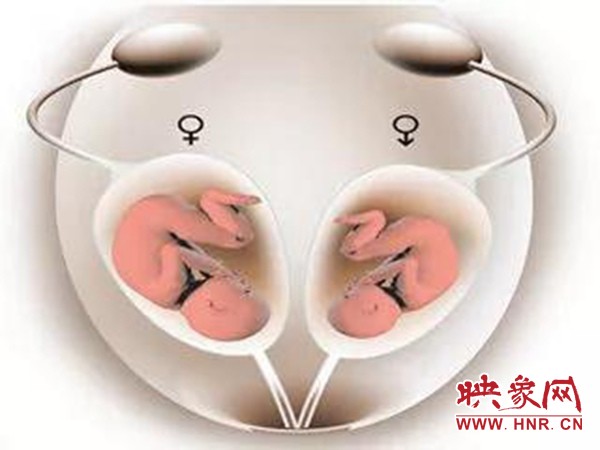 双子宫怀孕怎么睡觉好,双子宫孩子能足月降生吗
