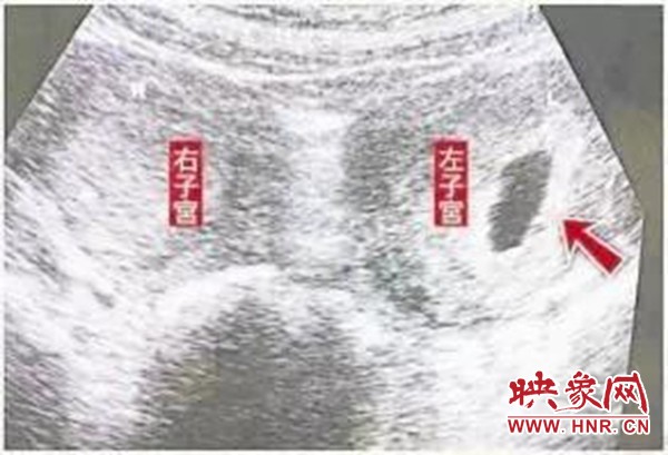 双子宫怀孕怎么睡觉好,双子宫孩子能足月降生吗