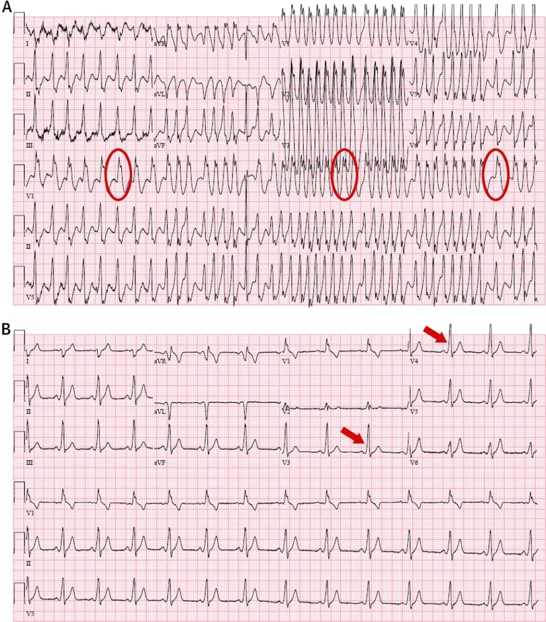 预激综合征合并房颤的慢性期治疗,预激综合征并发房颤是重大疾病吗