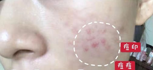 一招改善肩部疼痛,4个方法缓解肩周疼痛