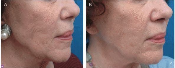 今年最火的美容仪,2023年最火的美容仪器有哪些