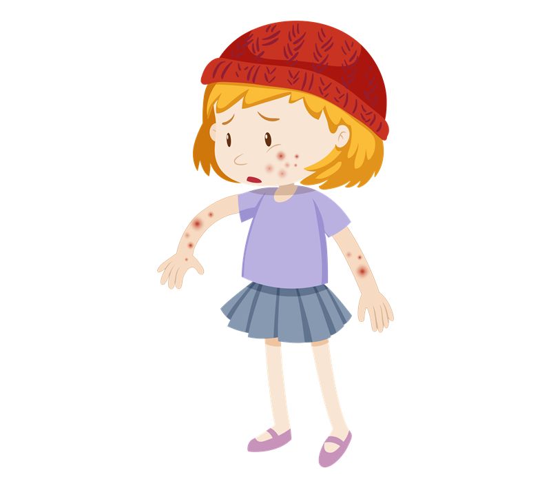 水痘高发期要注意什么,水痘进入高发期专家支招如何预防