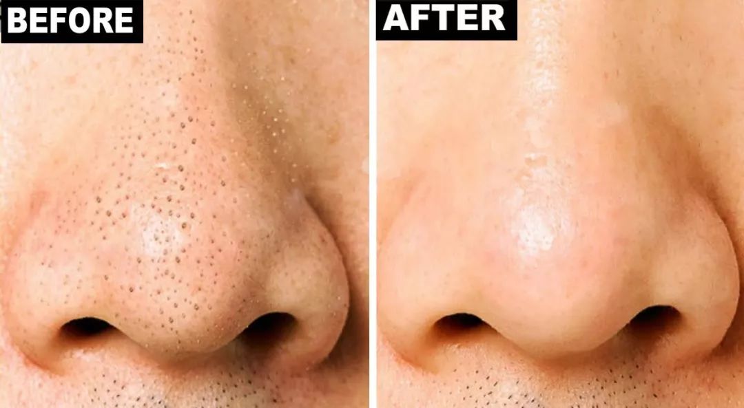 柔嫩抛光|脸上搓出3斤泥！难怪又黄又暗又黑头！10秒给脸蛋“剥壳”，厉害