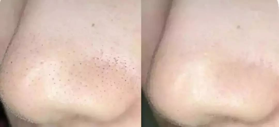 柔嫩抛光|脸上搓出3斤泥!难怪又黄又暗又黑头!10秒给脸蛋“剥壳”,厉害