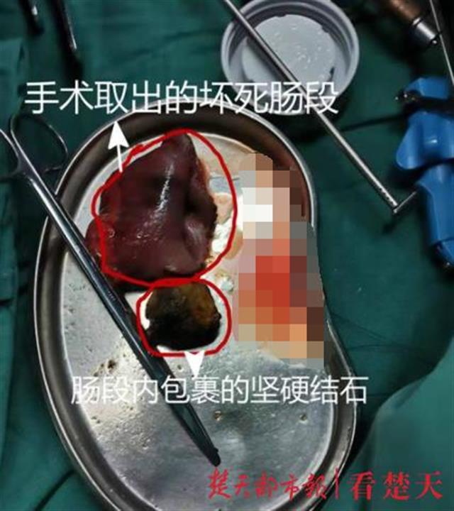 鸡蛋大硬石头“溜”进肠道,八旬老人“堵得慌”
