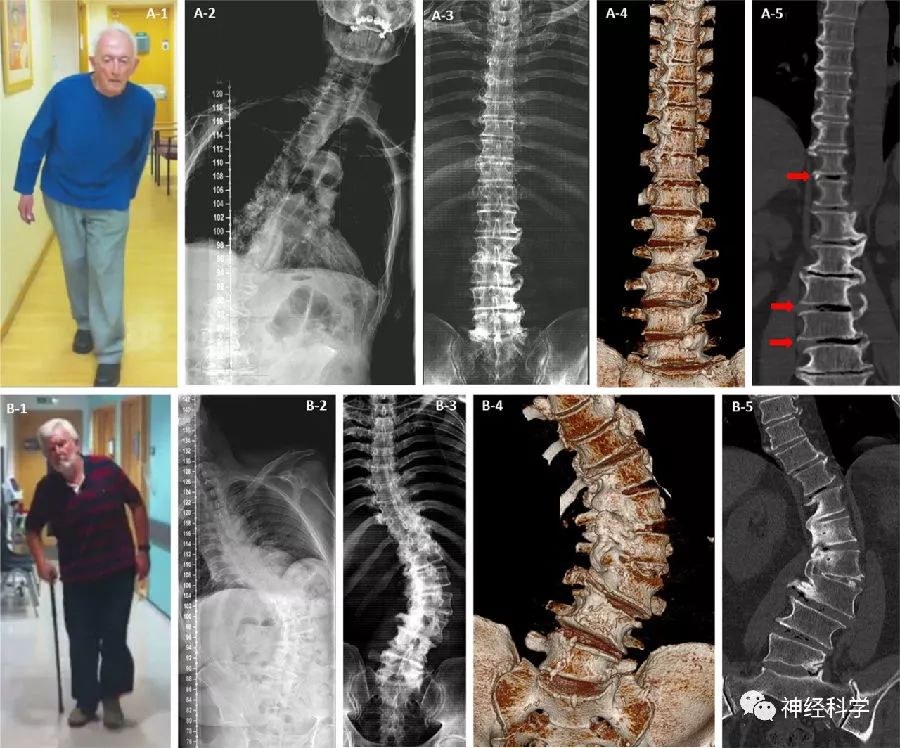 斜月沉沉藏海雾，碣石潇湘无限路——Pisa综合征