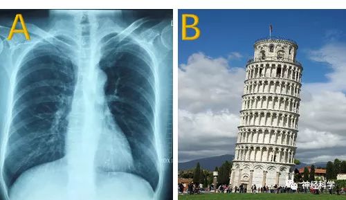 斜月沉沉藏海雾，碣石潇湘无限路——Pisa综合征