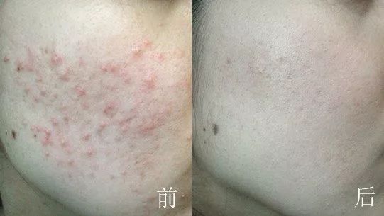 法国Lérane草本净螨贴，萃取天然植物，除螨更安心