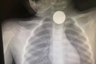 2岁女童误吞硬币当场窒息,儿童误吞硬币如何处理