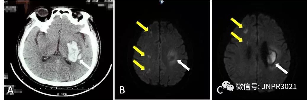 高血压脑出血保守治疗的恢复过程,高血压脑出血要保守治疗吗