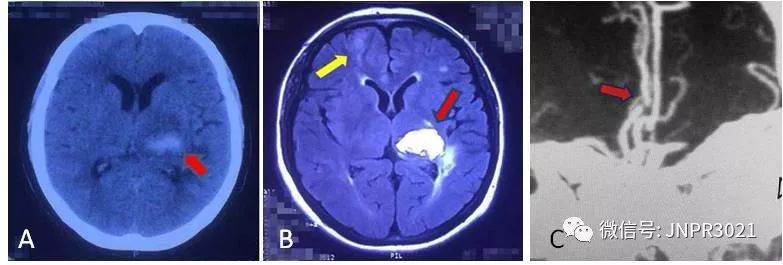 高血压脑出血保守治疗的恢复过程,高血压脑出血要保守治疗吗