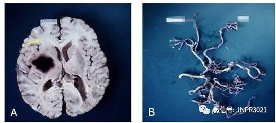 高血压脑出血保守治疗的恢复过程,高血压脑出血要保守治疗吗