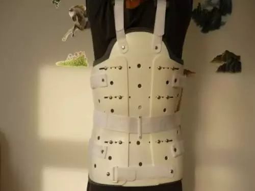 特发性脊柱侧弯的非手术康复治疗