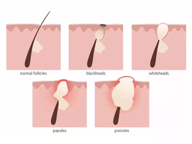 鼻子周围全是粉刺黑头,鼻子周围黑头反反复复毛孔大