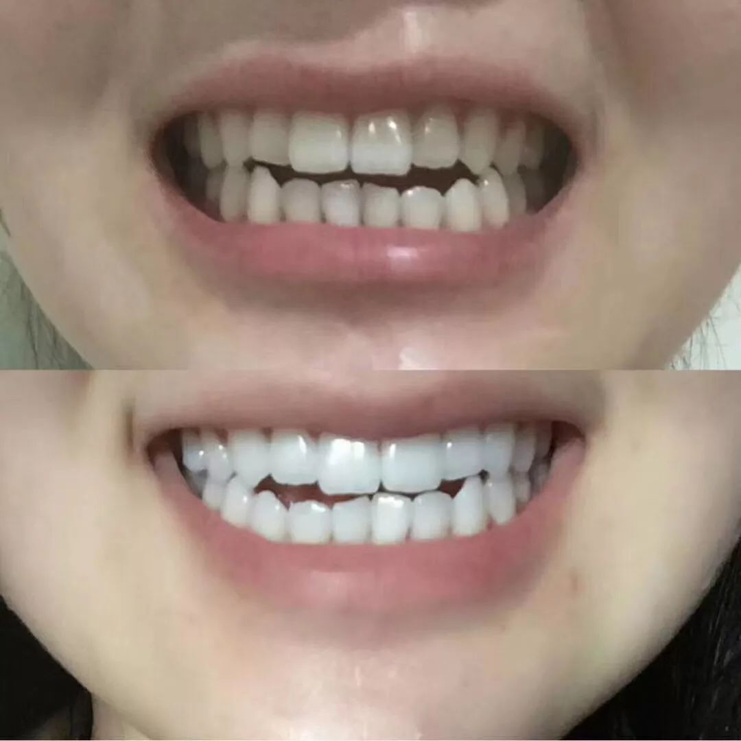 洗牙最好的牙刷,刷牙最干净不伤牙龈的牙刷