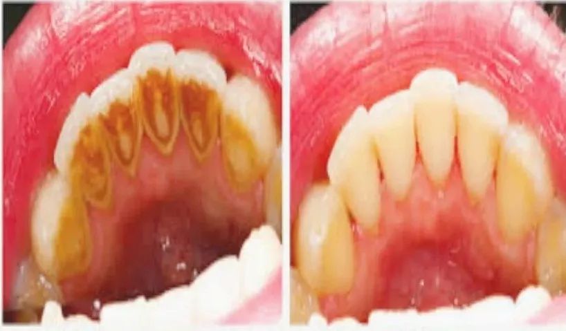 洗牙最好的牙刷,刷牙最干净不伤牙龈的牙刷