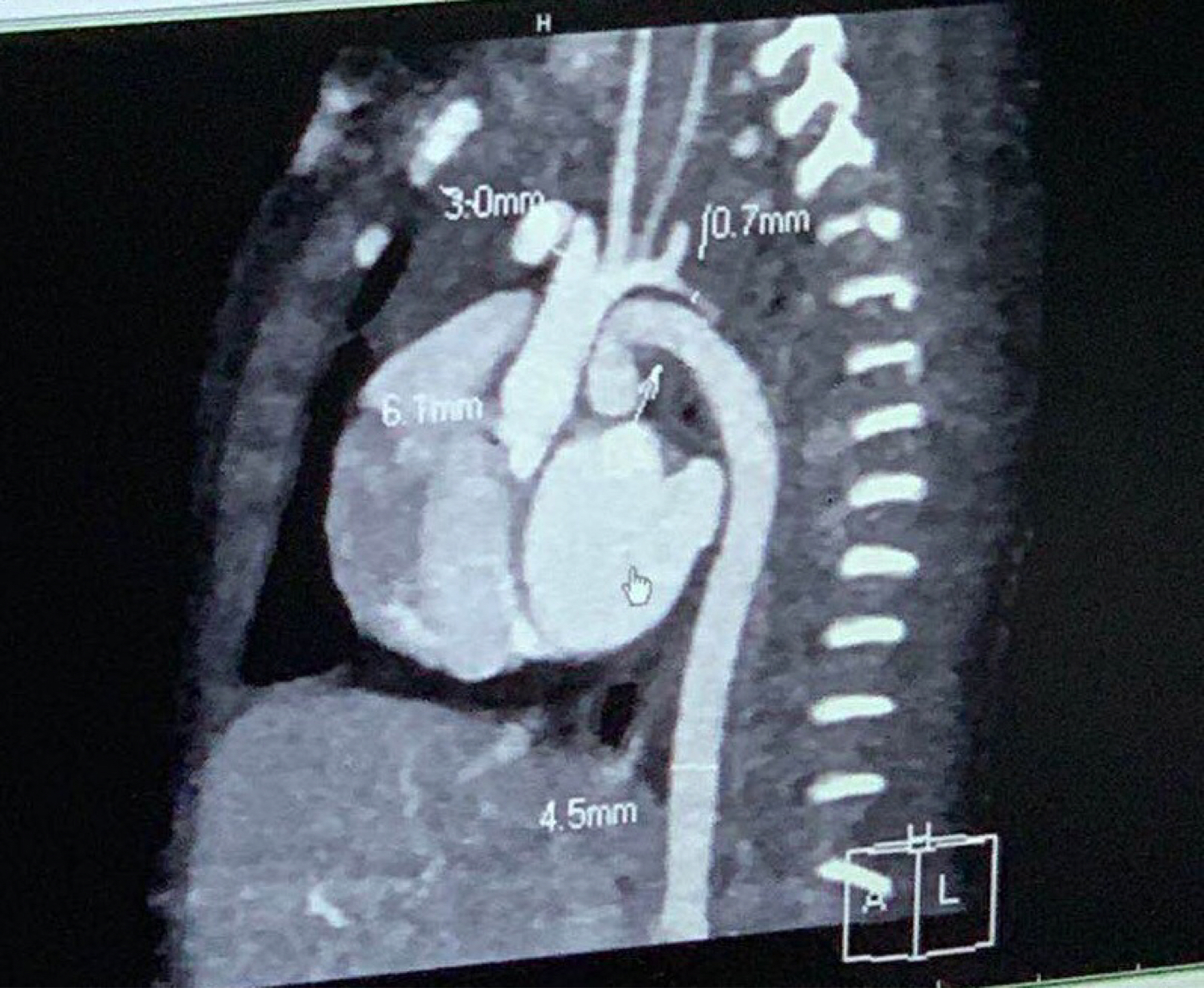 医患齐心、团队作战：新华医院成功救治患有严重先天性心脏病的1.5公斤极低体重早产儿