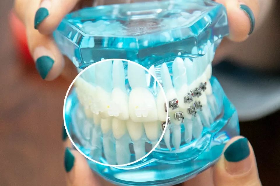 种牙免费送,种牙优惠活动免费检查是真的吗