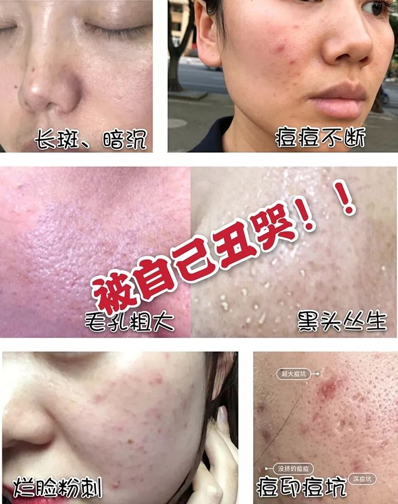 洗完脸后脸部还是能擦出脏东西,洗完脸后才知道脸上这么脏