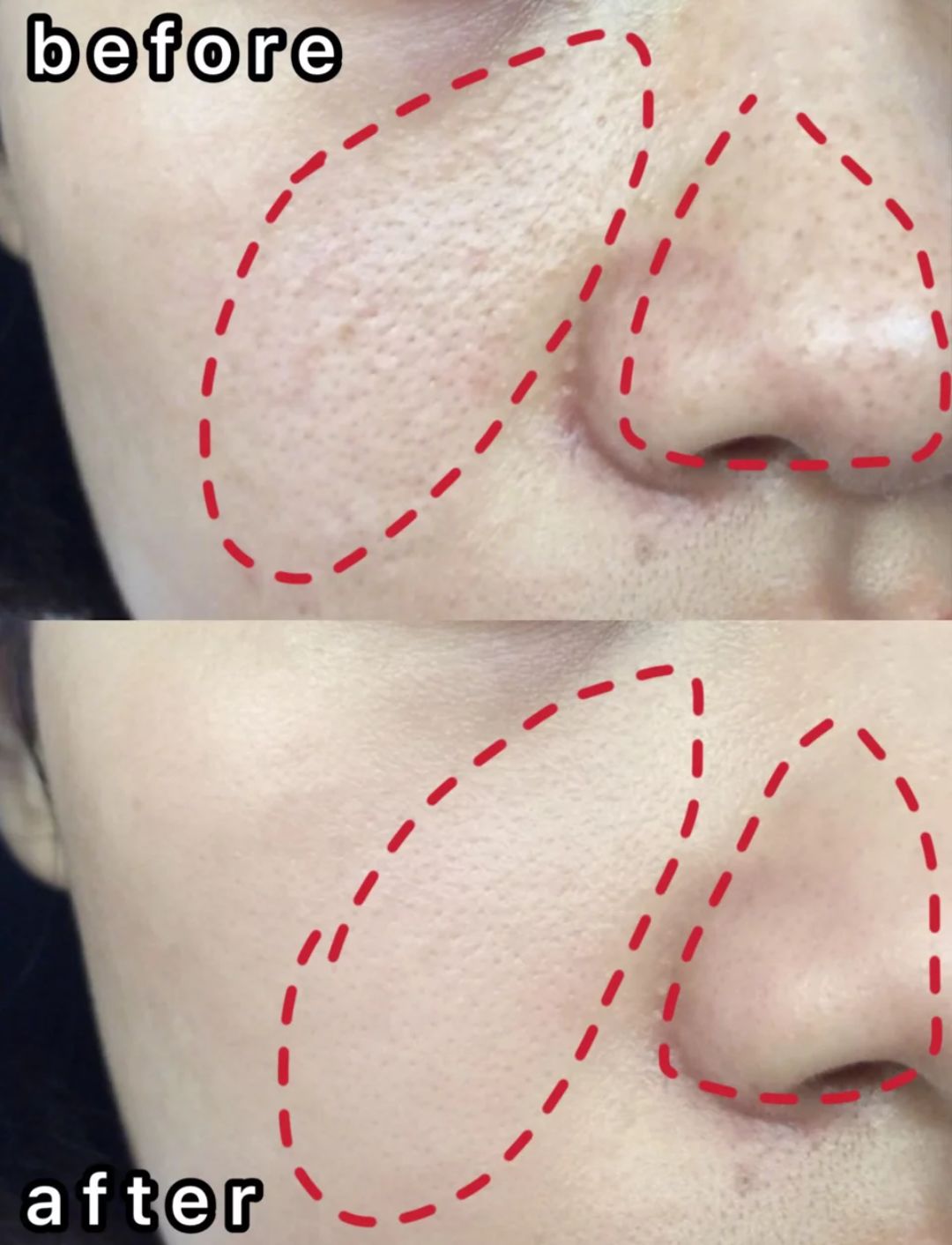 洗完脸后脸部还是能擦出脏东西,洗完脸后才知道脸上这么脏