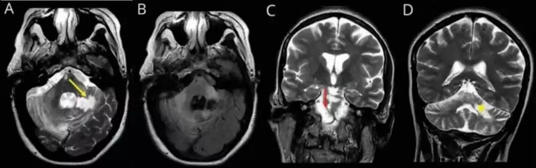 肥大性下橄榄核变性、Percheron动脉梗死、慢通道先天性肌无力综合征丨3分钟读片·31期