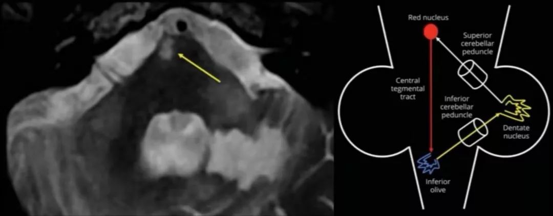 肥大性下橄榄核变性、Percheron动脉梗死、慢通道先天性肌无力综合征丨3分钟读片·31期