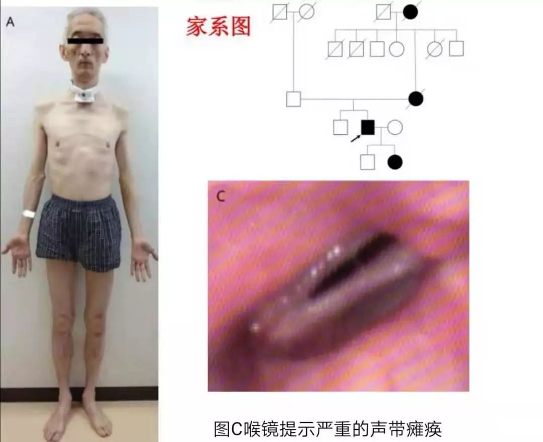 肥大性下橄榄核变性、Percheron动脉梗死、慢通道先天性肌无力综合征丨3分钟读片·31期