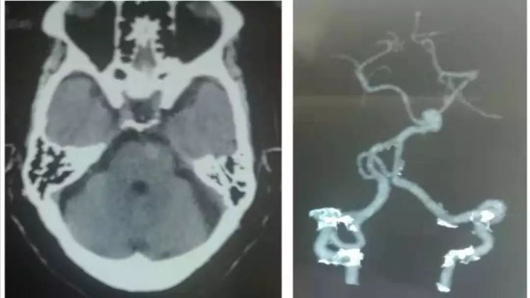 肥大性下橄榄核变性、Percheron动脉梗死、慢通道先天性肌无力综合征丨3分钟读片·31期