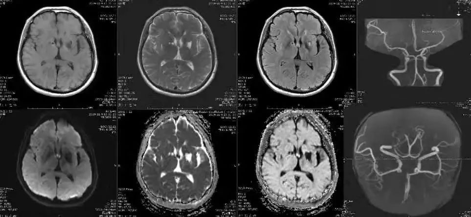 肥大性下橄榄核变性、Percheron动脉梗死、慢通道先天性肌无力综合征丨3分钟读片·31期