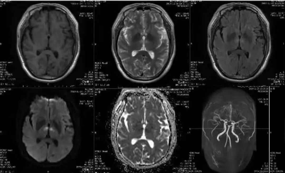 肥大性下橄榄核变性、Percheron动脉梗死、慢通道先天性肌无力综合征丨3分钟读片·31期