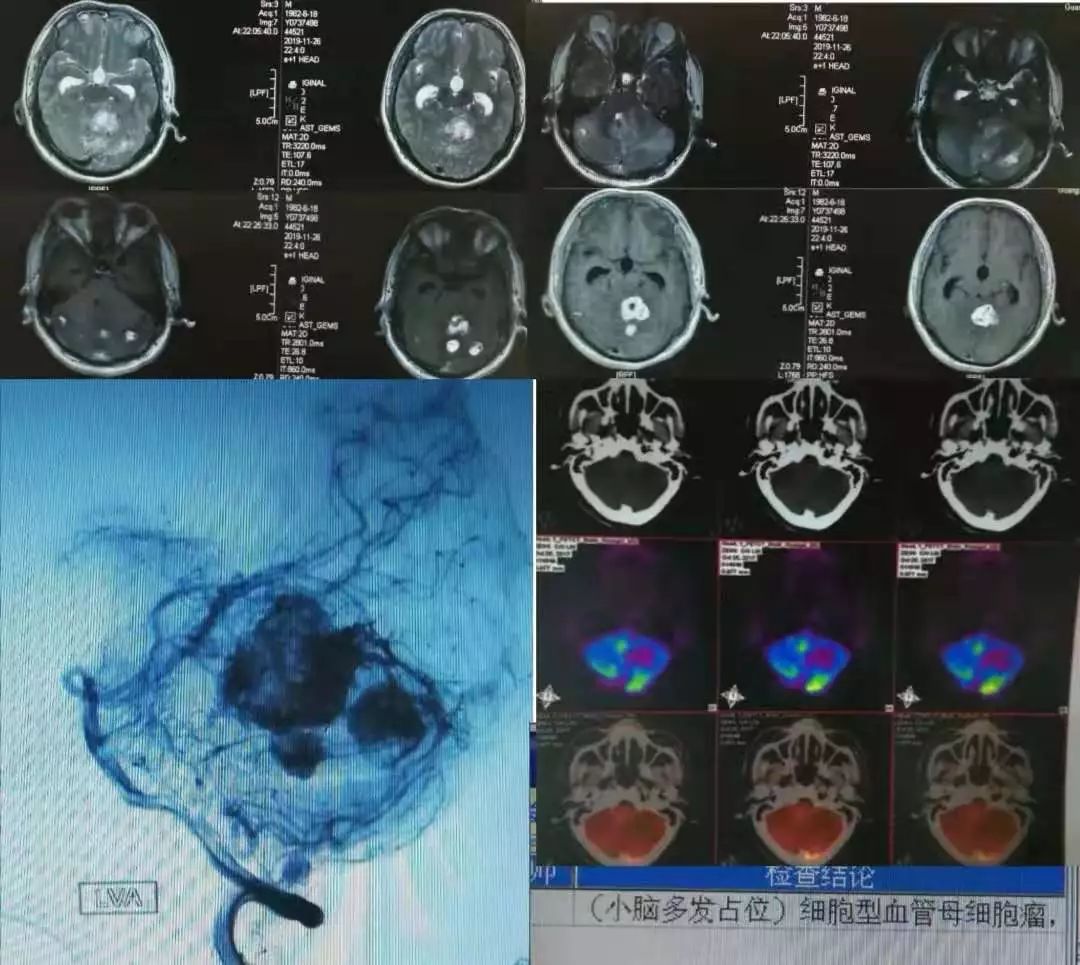 肥大性下橄榄核变性、Percheron动脉梗死、慢通道先天性肌无力综合征丨3分钟读片·31期