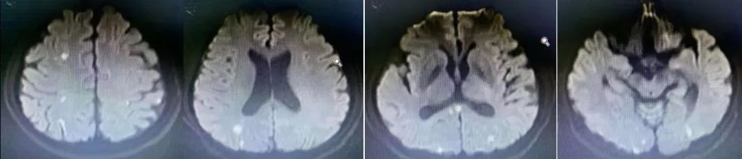 肥大性下橄榄核变性、Percheron动脉梗死、慢通道先天性肌无力综合征丨3分钟读片·31期