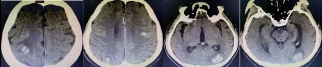 肥大性下橄榄核变性、Percheron动脉梗死、慢通道先天性肌无力综合征丨3分钟读片·31期