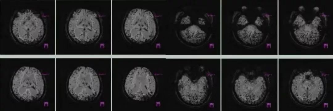 肥大性下橄榄核变性、Percheron动脉梗死、慢通道先天性肌无力综合征丨3分钟读片·31期