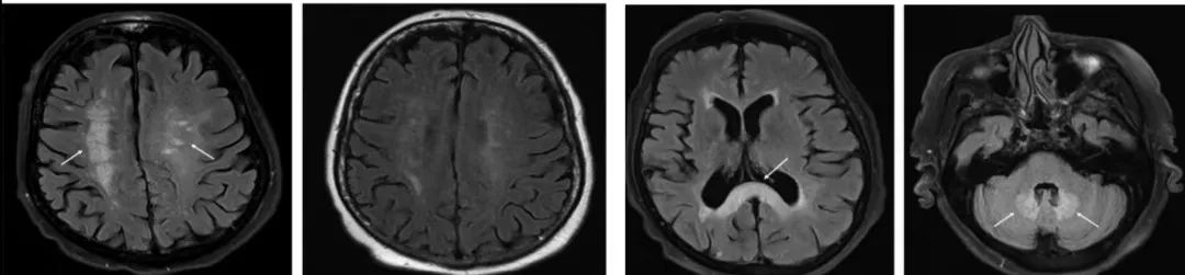 肥大性下橄榄核变性、Percheron动脉梗死、慢通道先天性肌无力综合征丨3分钟读片·31期