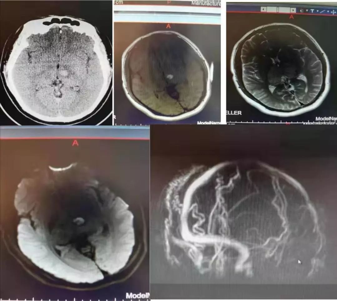 肥大性下橄榄核变性、Percheron动脉梗死、慢通道先天性肌无力综合征丨3分钟读片·31期