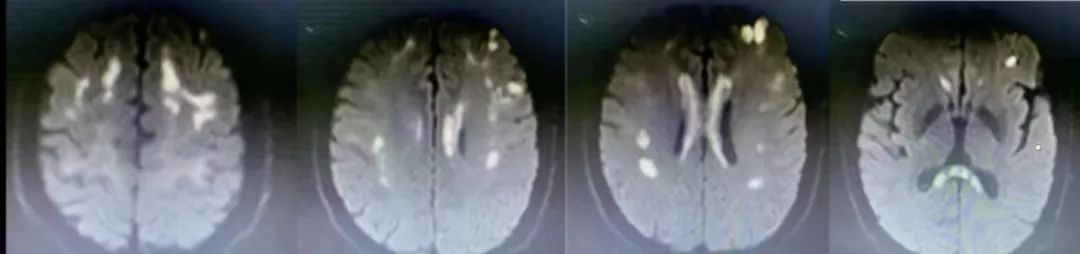 肥大性下橄榄核变性、Percheron动脉梗死、慢通道先天性肌无力综合征丨3分钟读片·31期