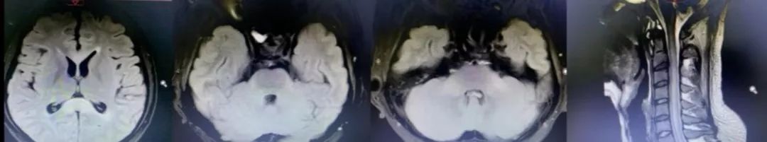 肥大性下橄榄核变性、Percheron动脉梗死、慢通道先天性肌无力综合征丨3分钟读片·31期