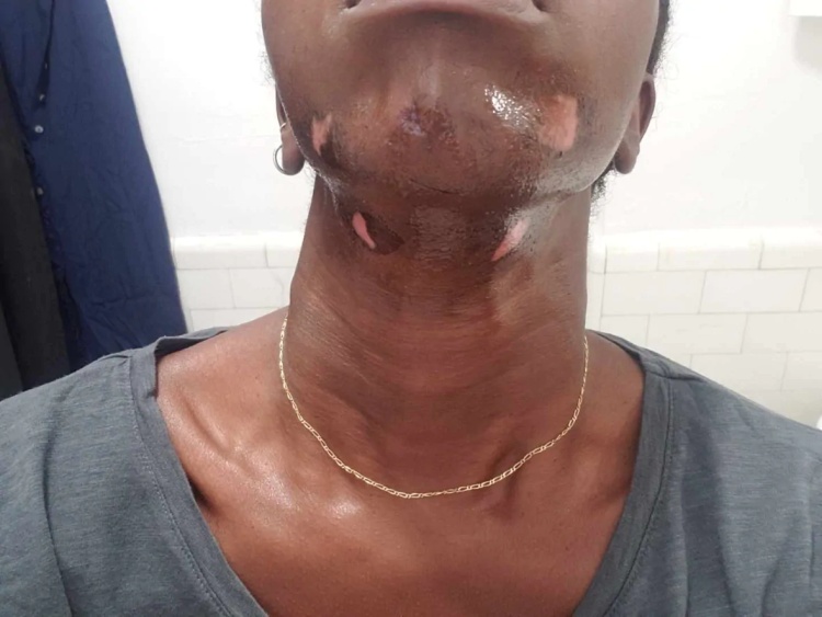 多伦多女子激光脱毛，只因一个签名被毁容也投诉无门