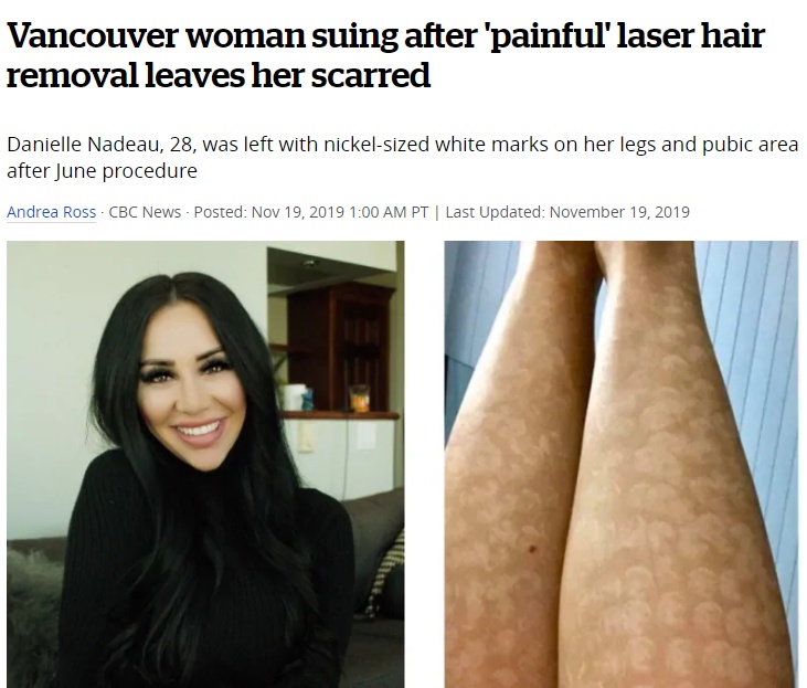 多伦多女子激光脱毛，只因一个签名被毁容也投诉无门