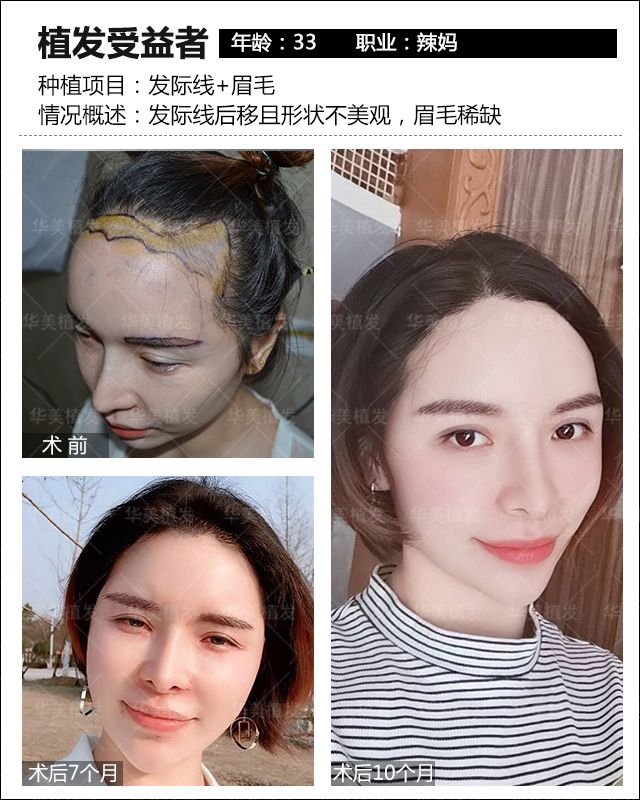 脱发严重发际线都看得很清楚了,脱发严重发际线高怎么解决