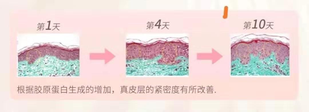 祛皱纹黑科技,除皱黑科技90秒除皱