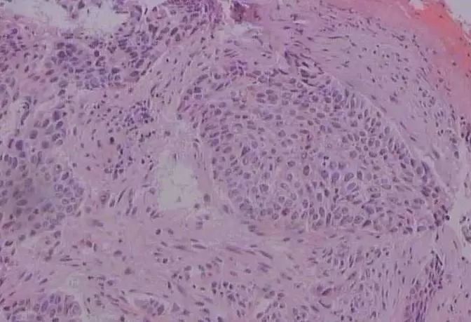 反了！人体“铠甲”变“僵尸”，这种癌症，忽视就晚了