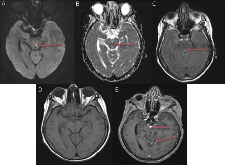 追「根」溯源：免疫功能正常，为什么出现多颅神经麻痹、共济失调？丨临床推理