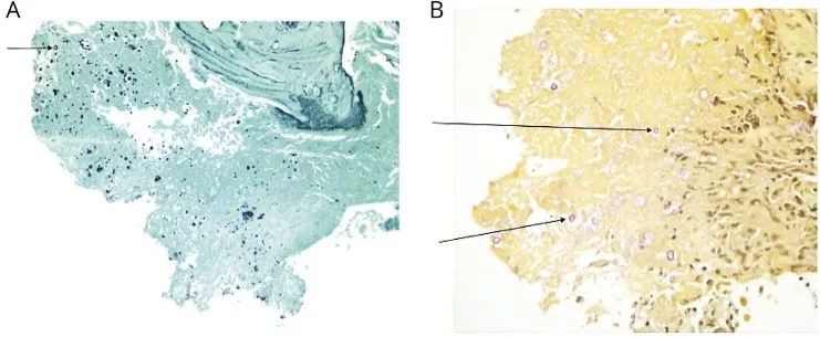 追「根」溯源：免疫功能正常，为什么出现多颅神经麻痹、共济失调？丨临床推理