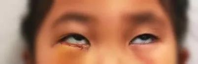 春节寒假高发！4岁女孩玩耍时不小心摔跤，结果右眼眶骨折，眼球不能转动