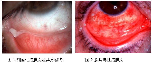 疫情期间结膜炎会被隔离吗,一张图看懂急性结膜炎