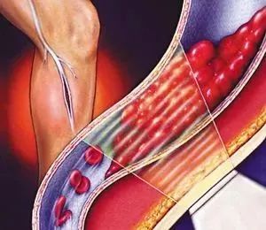 picc置管期间的主要并发症有,picc置管最常见的并发症